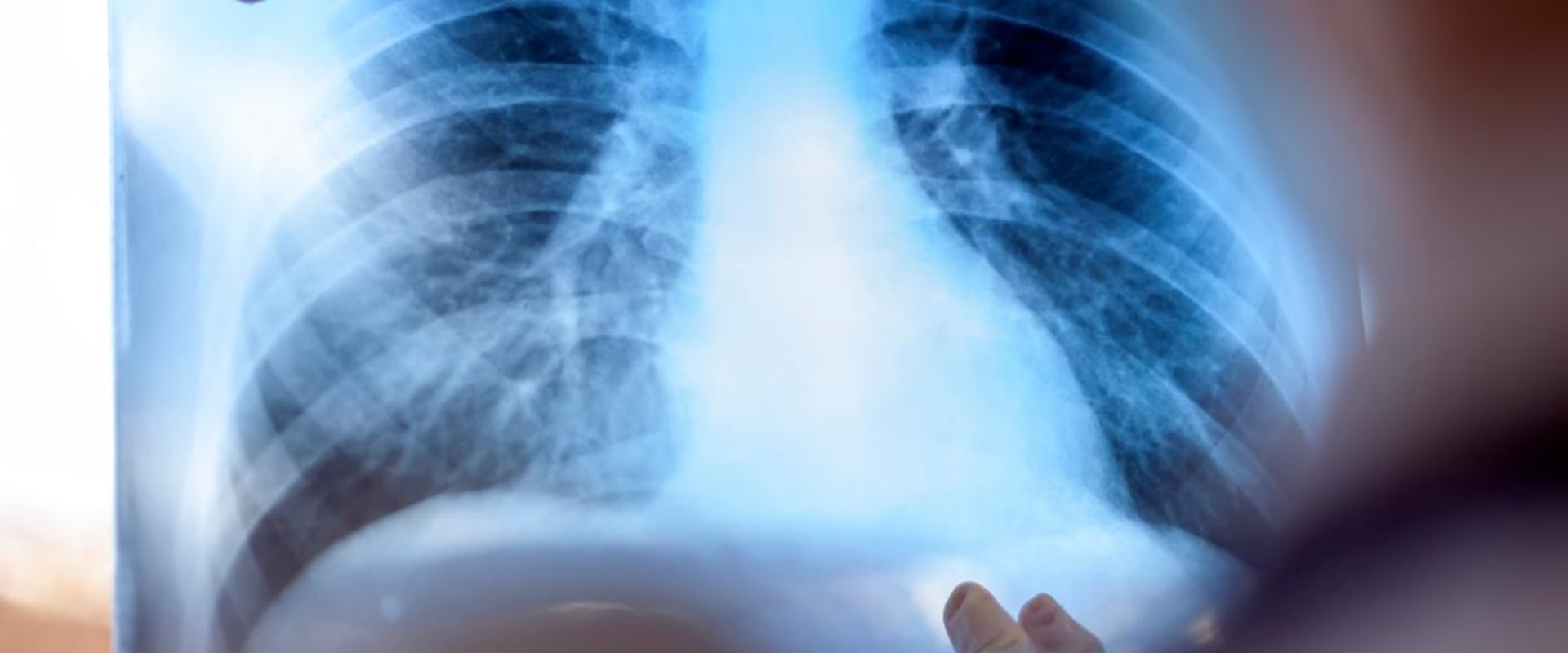 Estimating Exposure Dose from X-Ray Badge Results