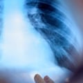 Estimating Exposure Dose from X-Ray Badge Results