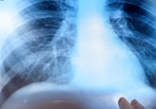 Estimating Exposure Dose from X-Ray Badge Results